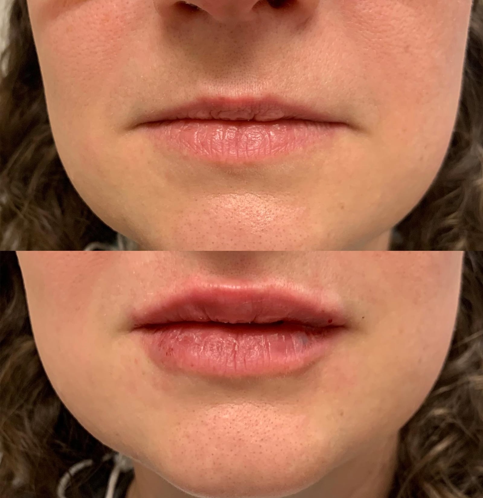 Dermal Fillers So Popular Today Dermal Fillers So Popular Today