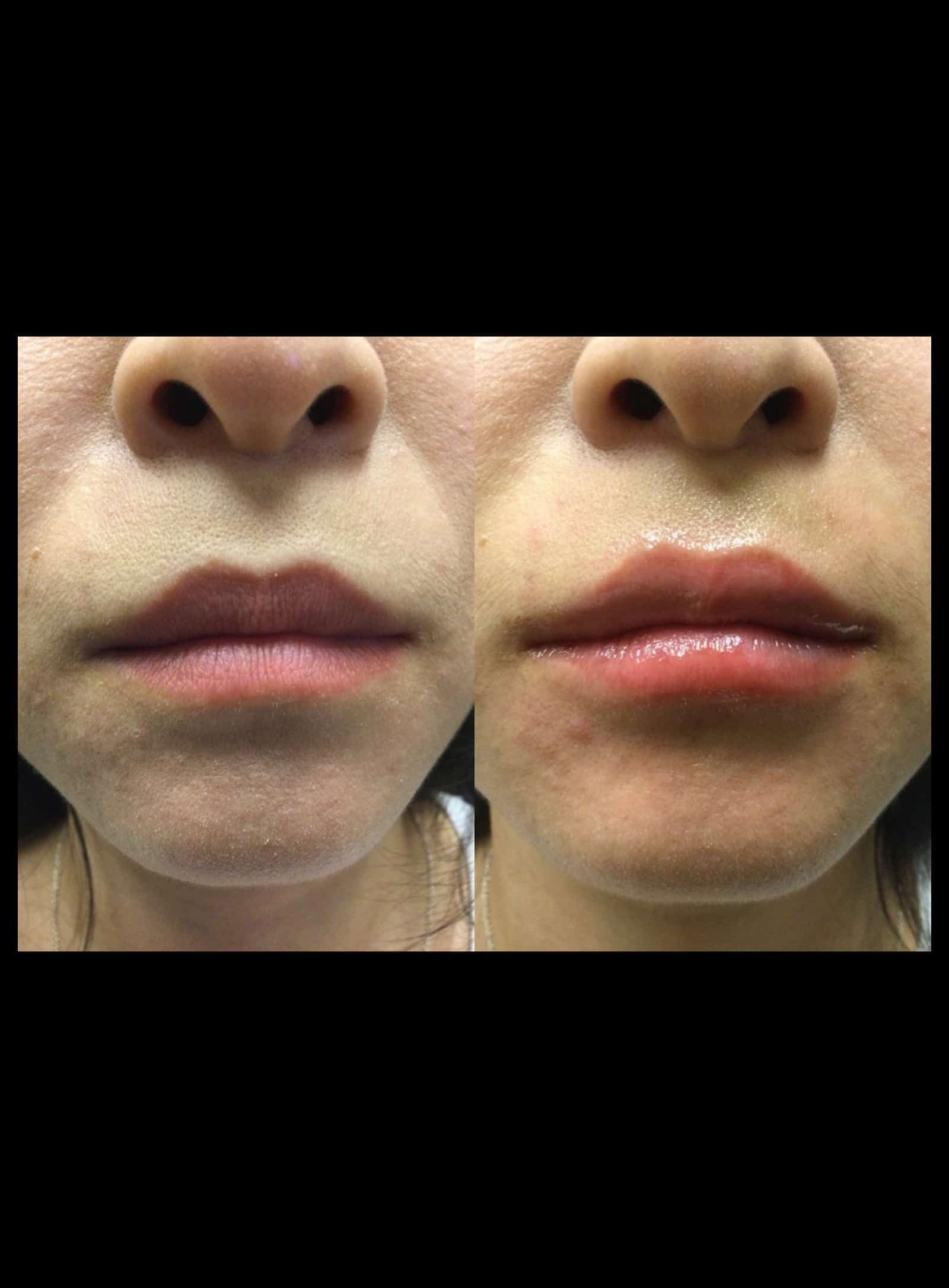 Facial Aging and Volume Loss