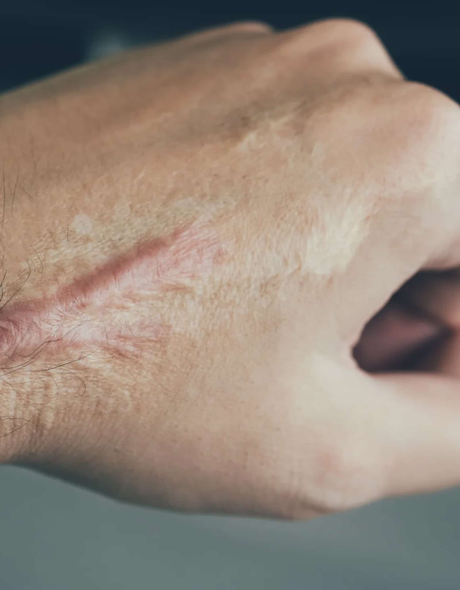 Keloid Removal Keloid Removal