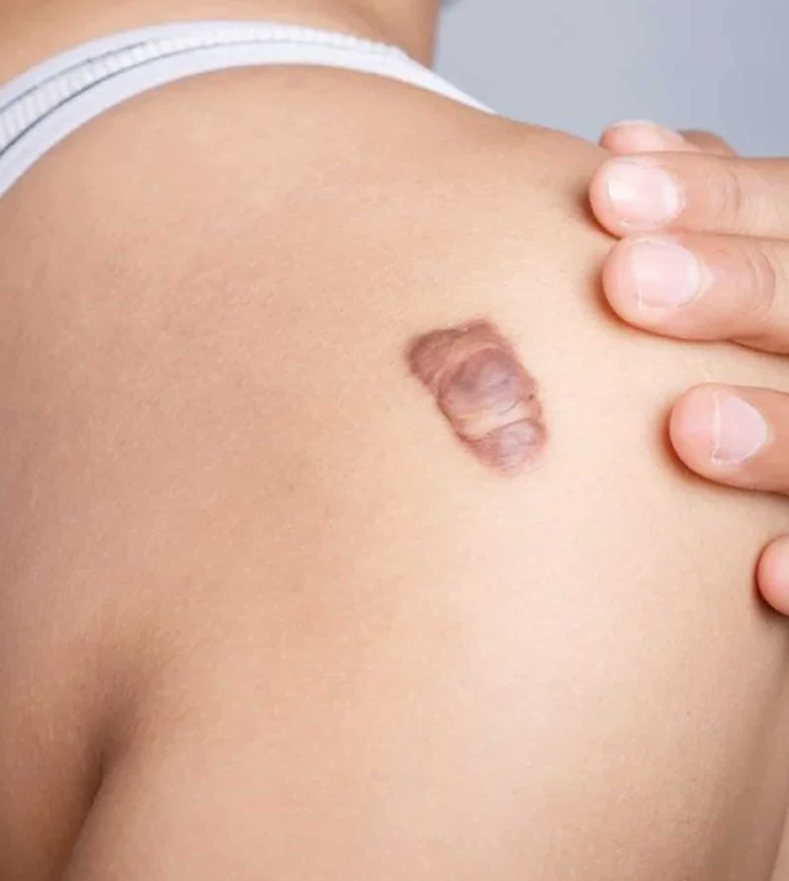 Keloid Scars Keloid Scars