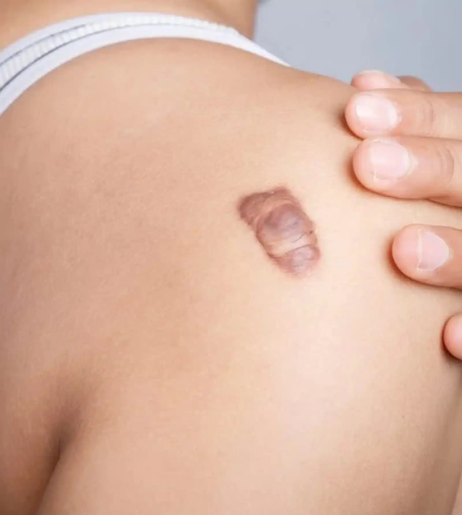 Keloid Scars Keloid Scars