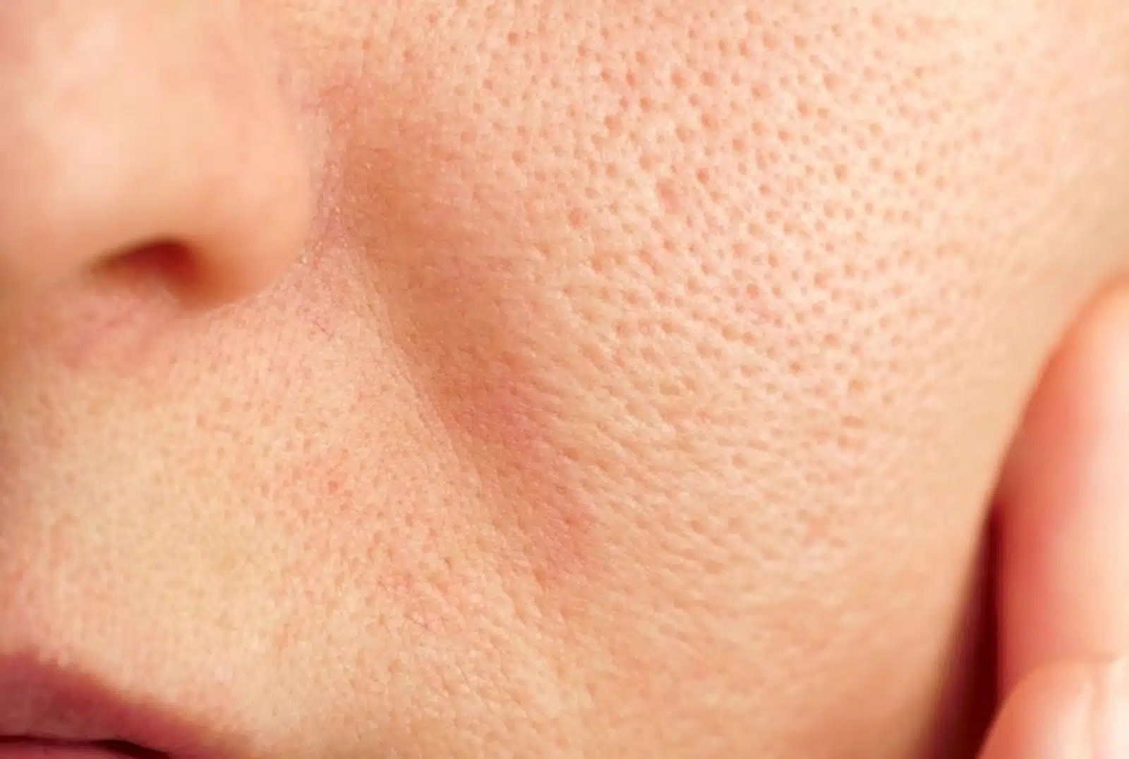 Fine lines & wrinkles