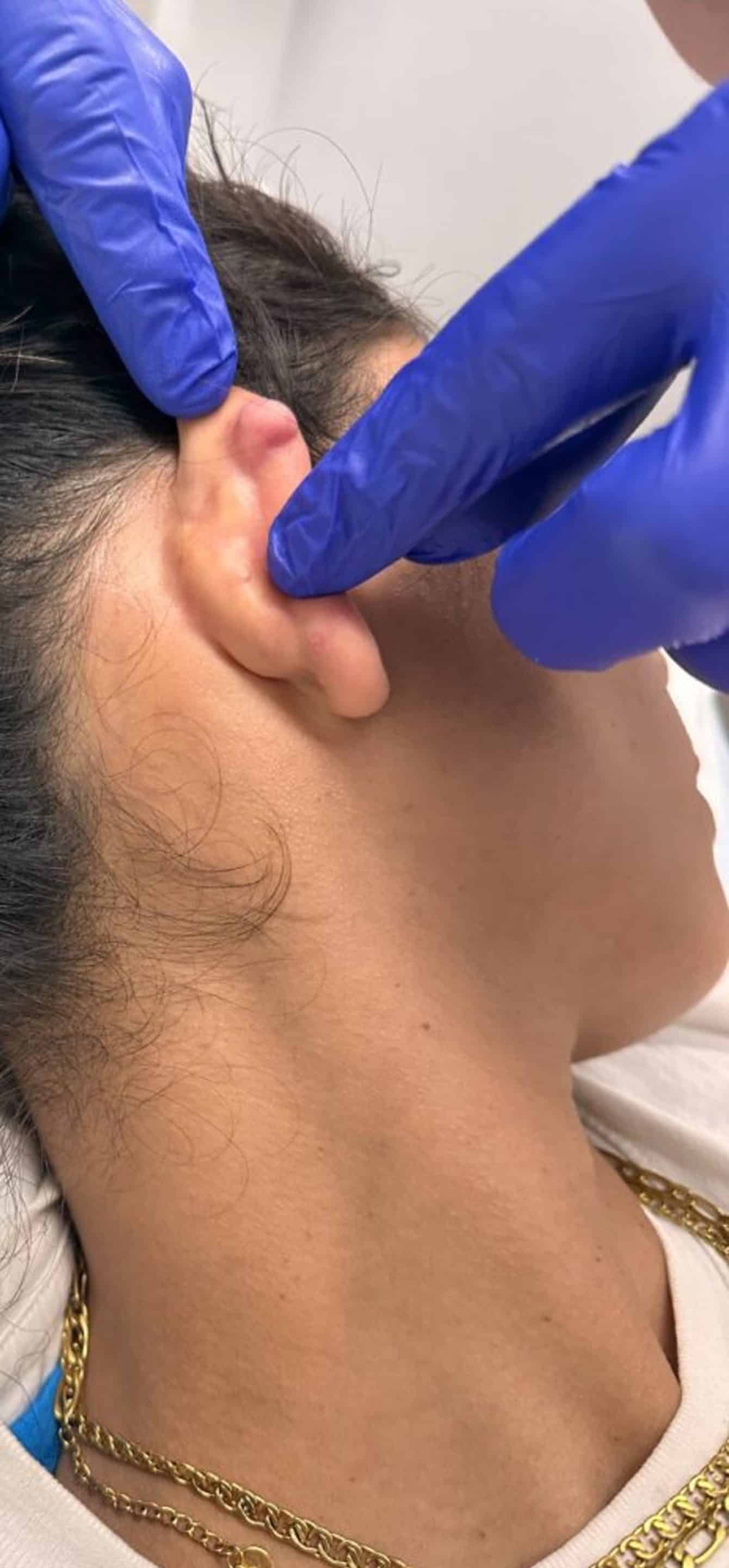 Laser Therapy for Keloid Reduction Laser Therapy for Keloid Reduction