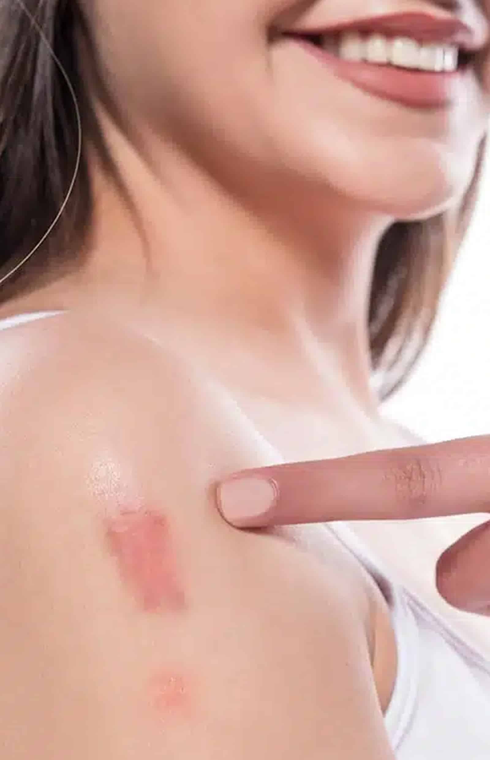 Thick, dense scar tissue Thick, dense scar tissue