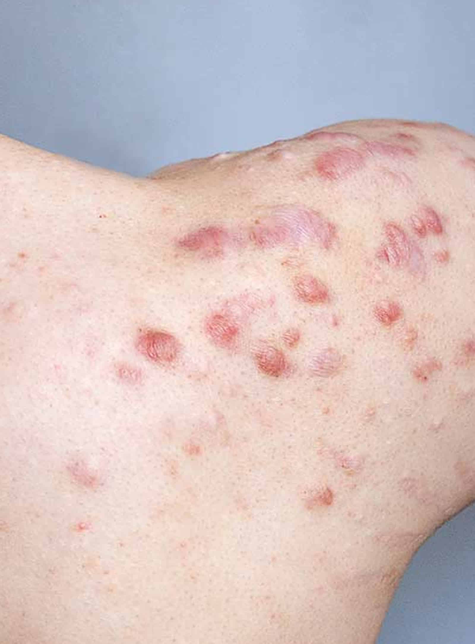 Treatment Is Necessary for Keloids Treatment Is Necessary for Keloids