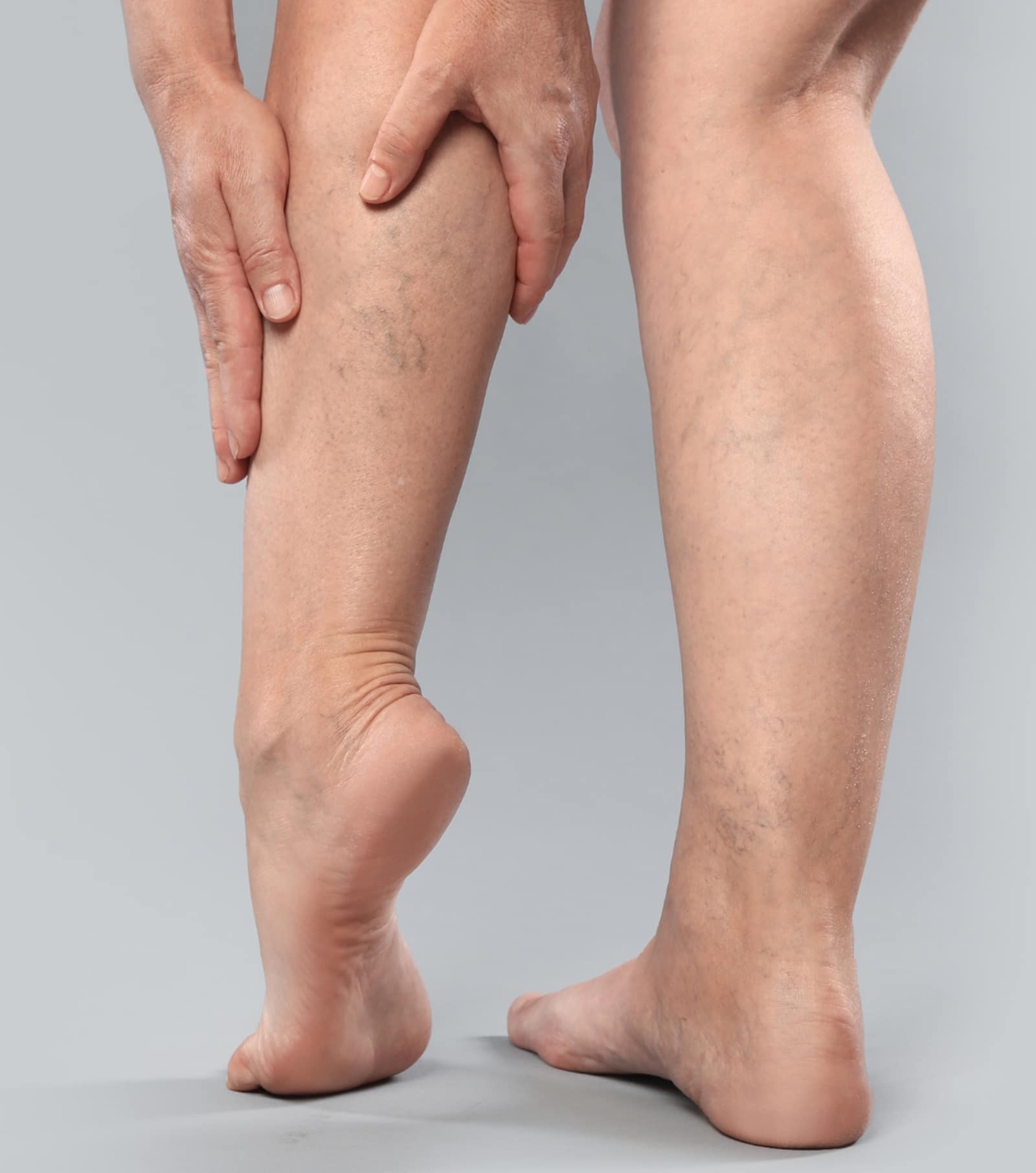 Causes Spider Veins and Varicose Veins Causes Spider Veins and Varicose Veins