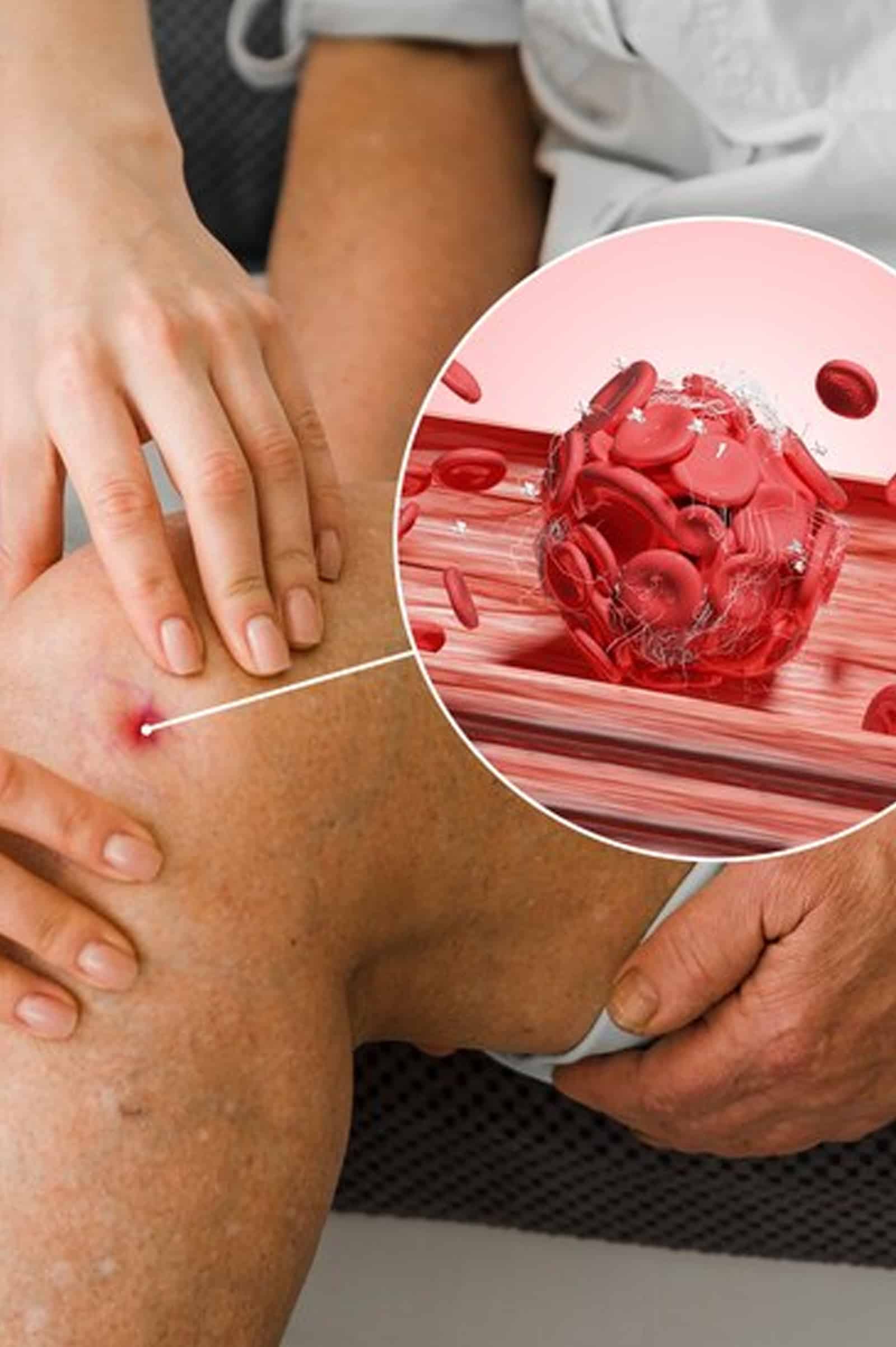 Causes Visible Veins on Legs and Face Causes Visible Veins on Legs and Face