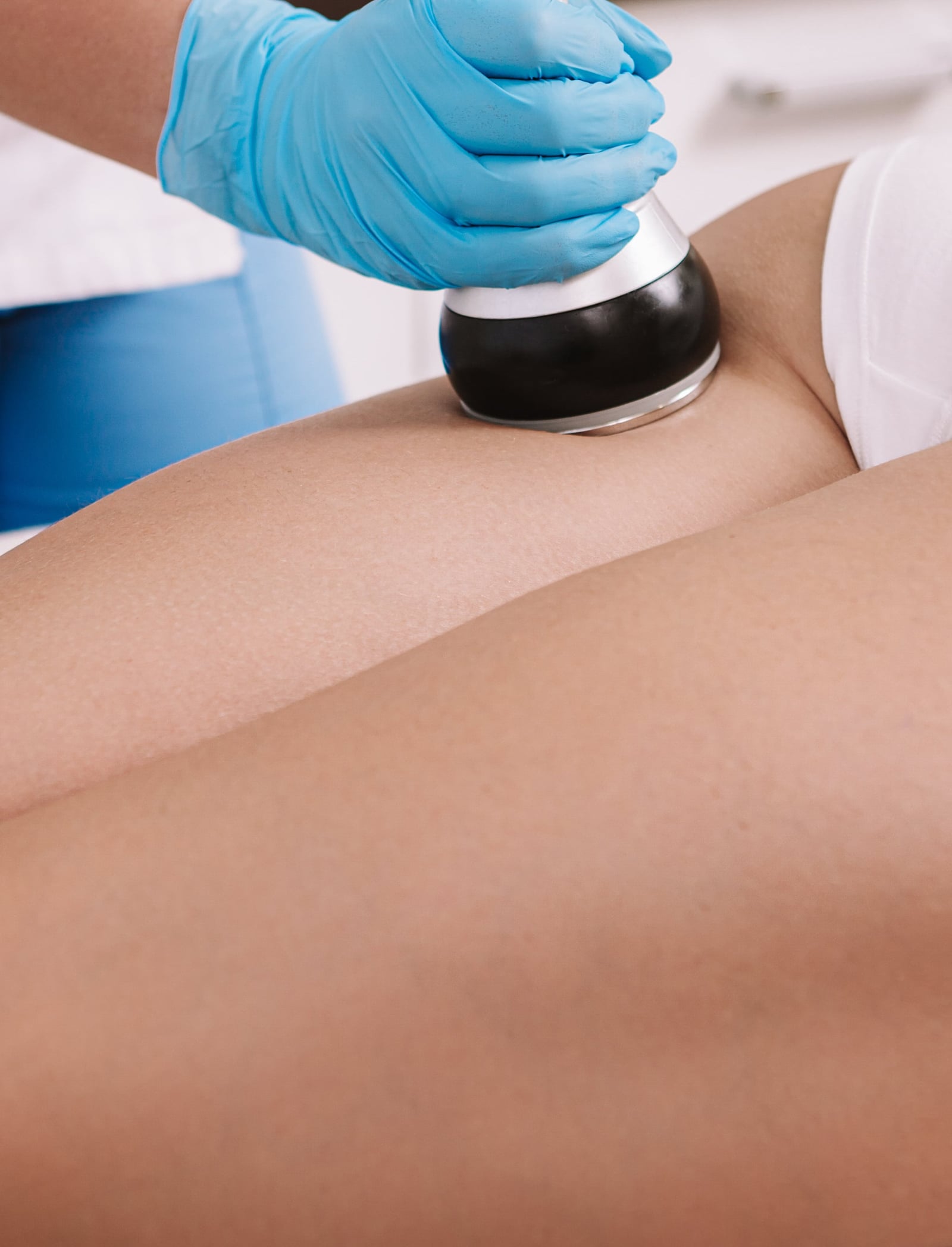 Laser-Assisted Cellulite Reduction