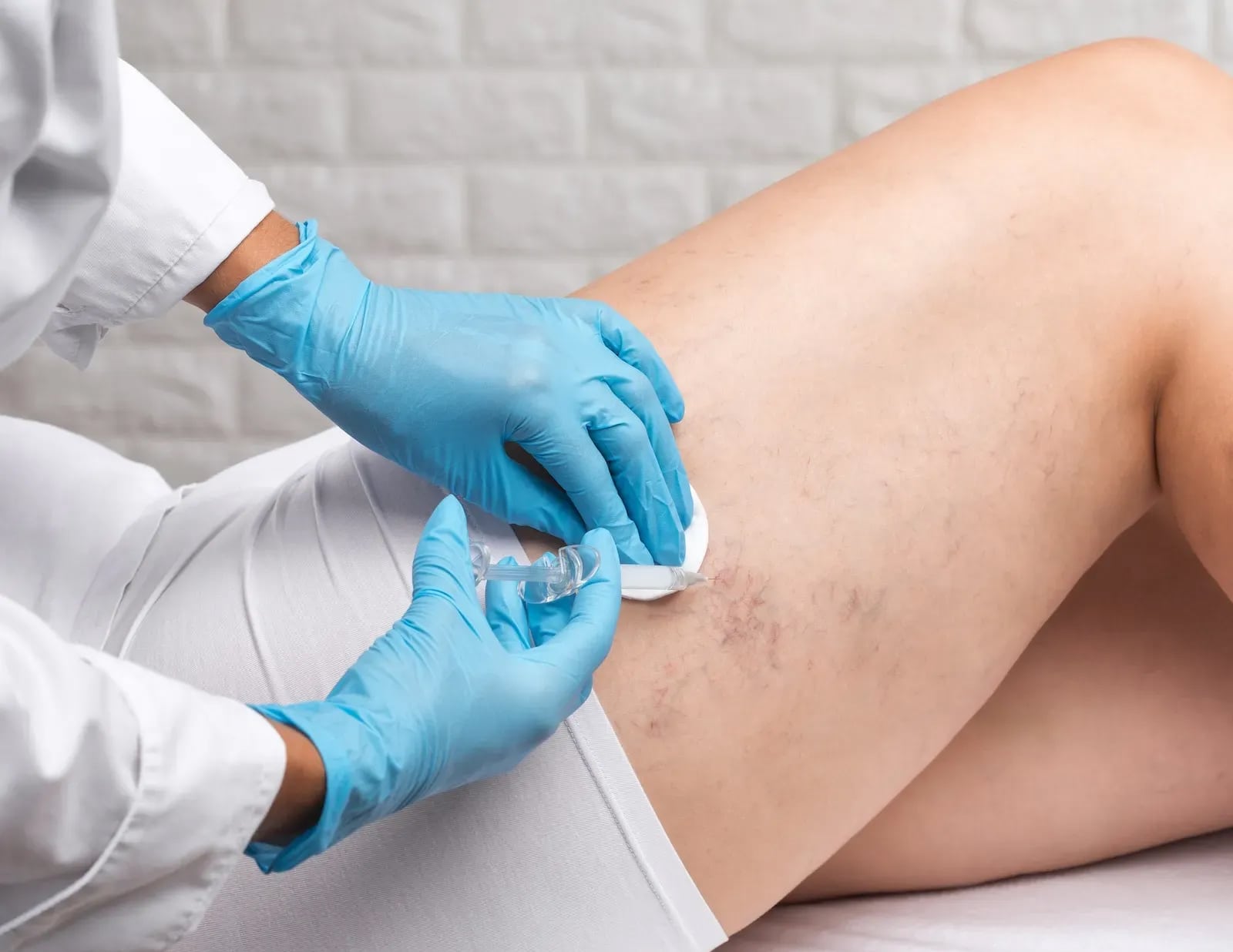 Expert Vein Treatment Near You for Clearer Expert Vein Treatment Near You for Clearer
