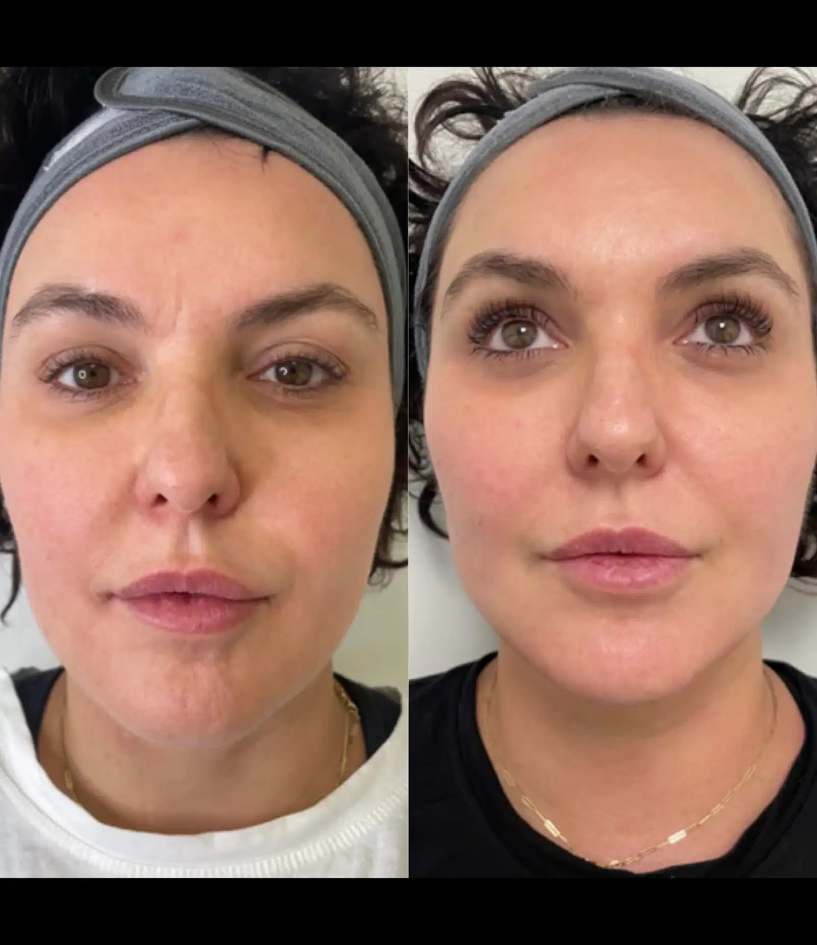 Smoother skin texture Smoother skin texture