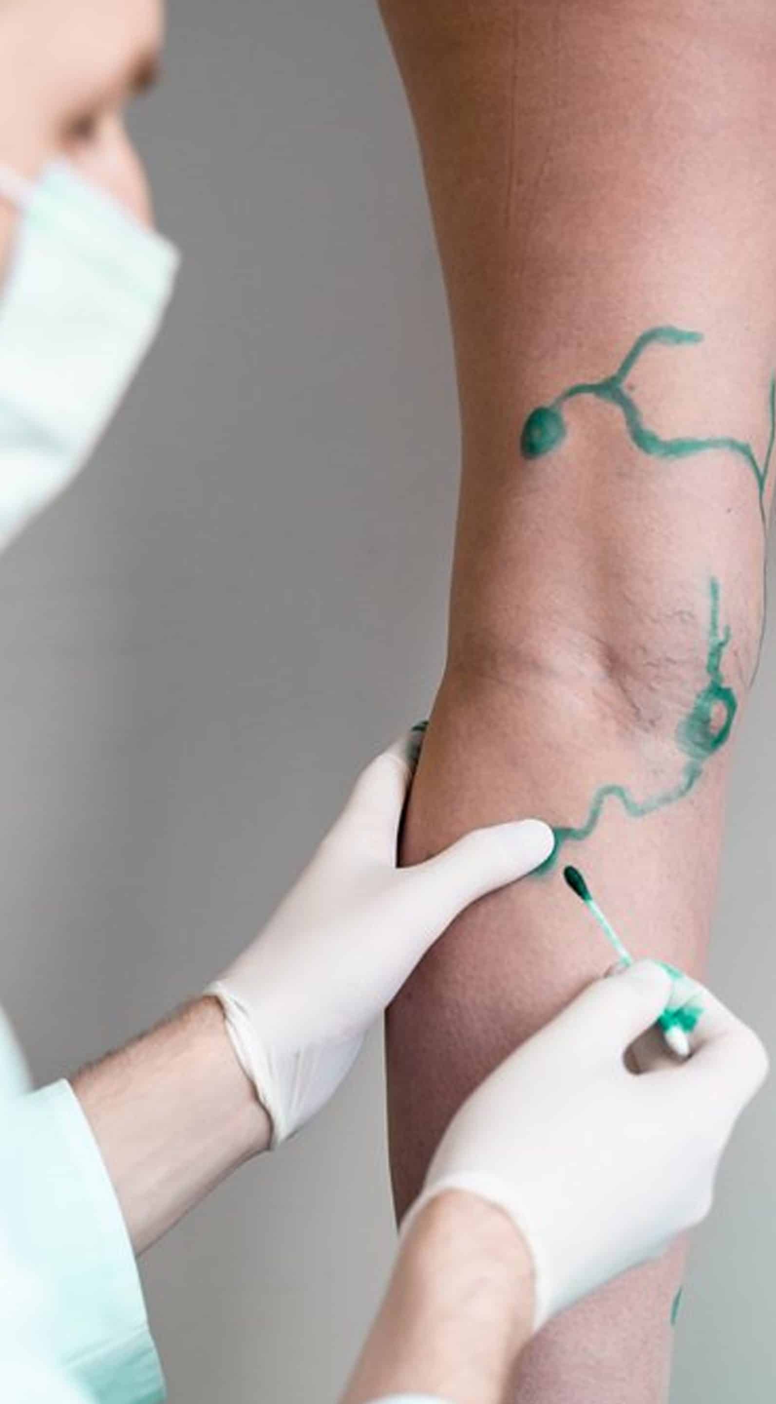 Vein Conditions We Treat Vein Conditions We Treat