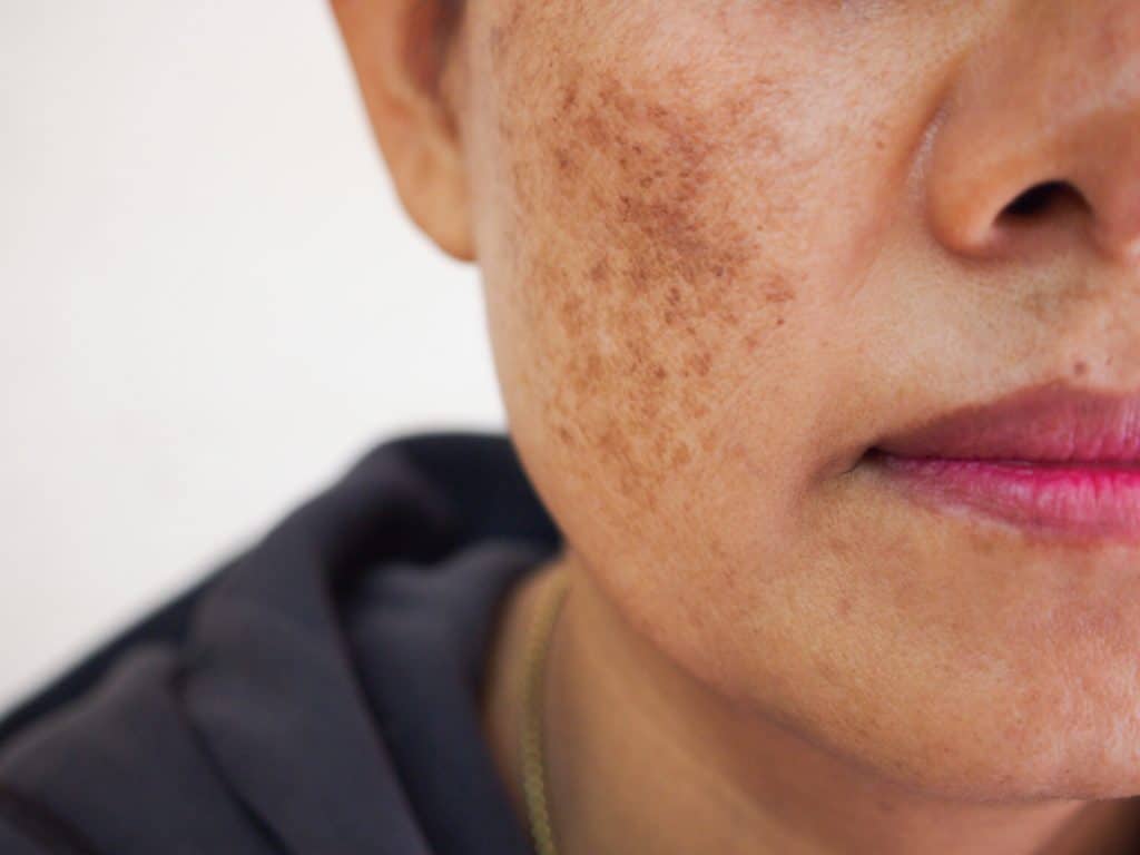 how to get rid of melasma fast orlando