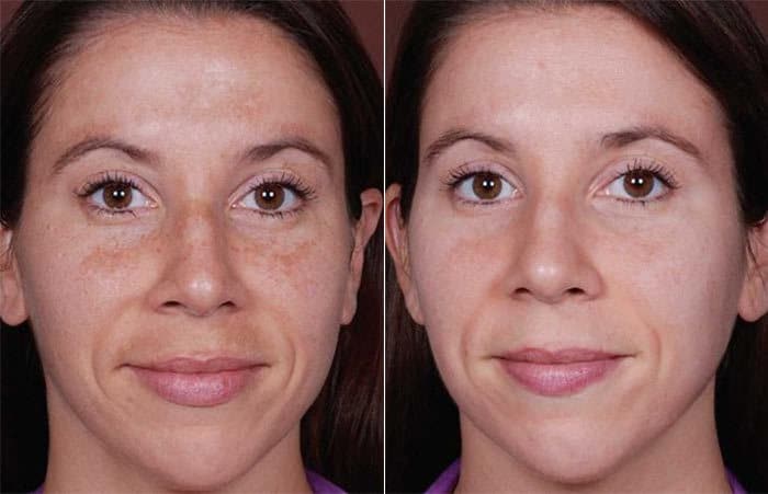how to get rid of melasma fast orlando