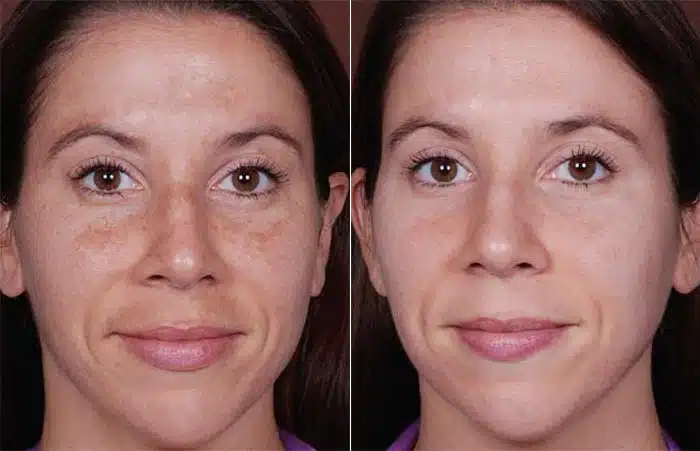 how to get rid of melasma fast orlando