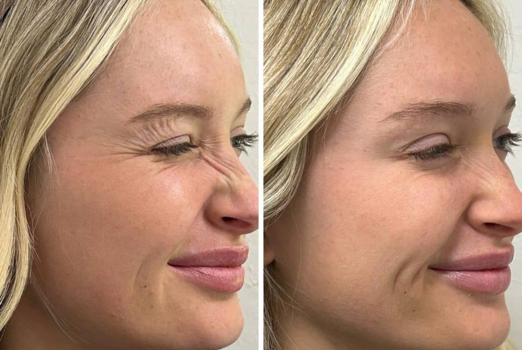 nose wrinkle treatment