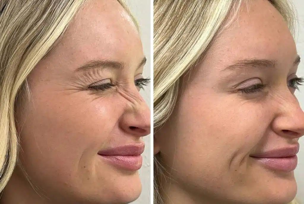nose wrinkle treatment