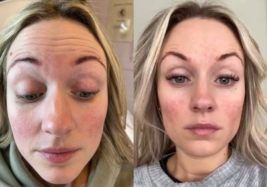 nose wrinkle treatment