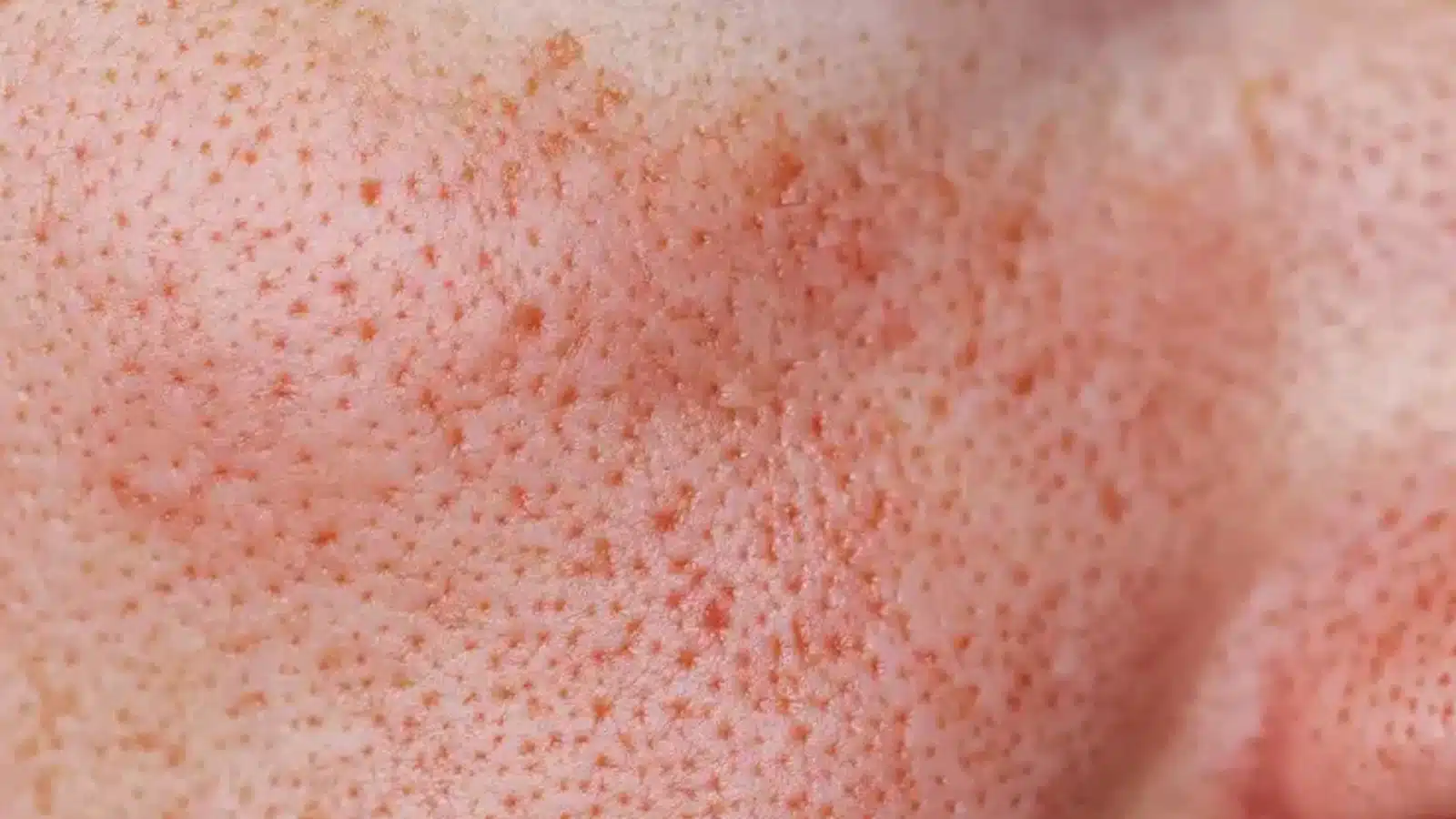 CoolMax Pro Peel