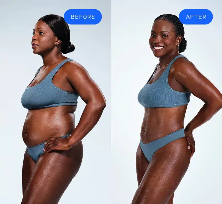 How Does CoolSculpting Work?