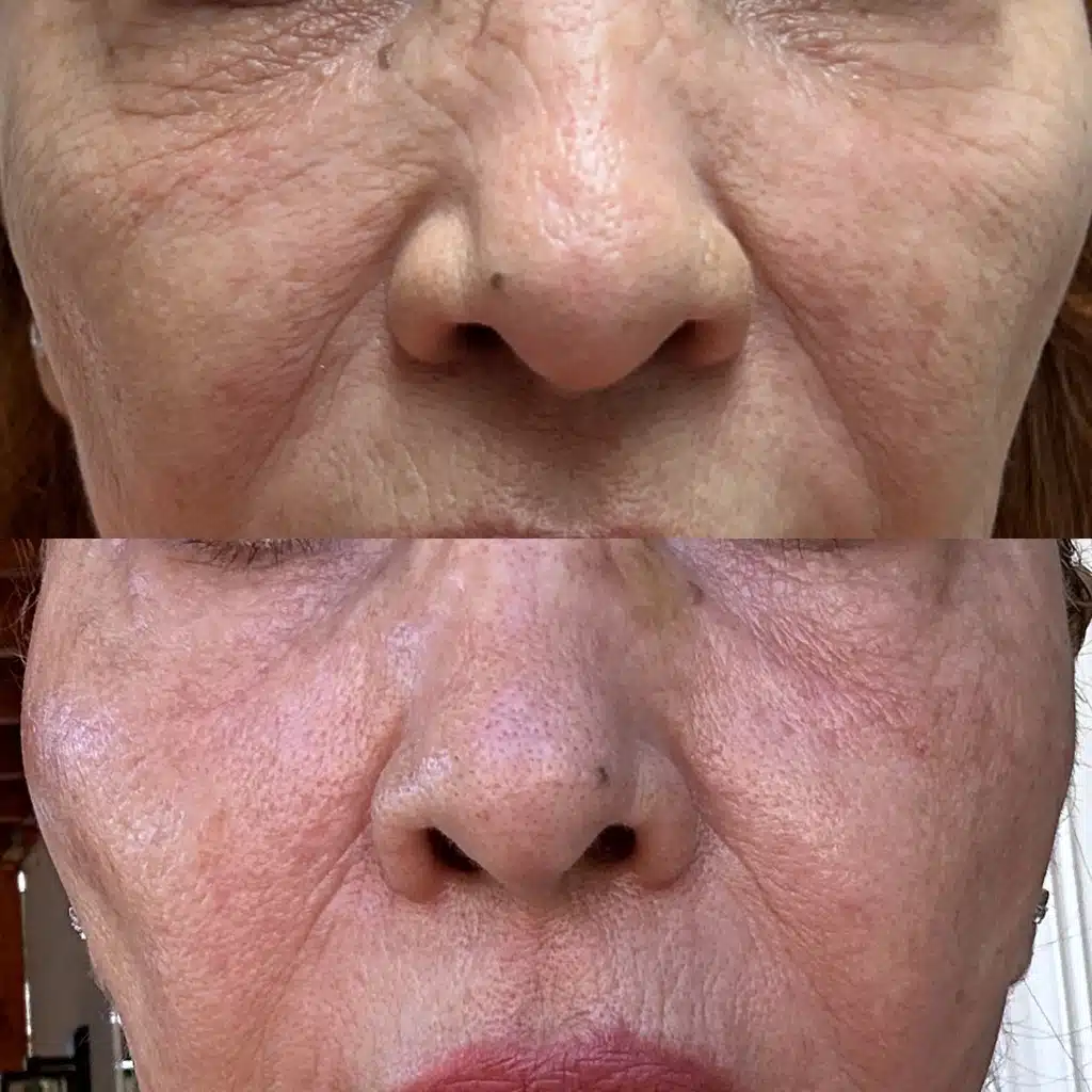 Peel Mode vs. Deep Resurfacing