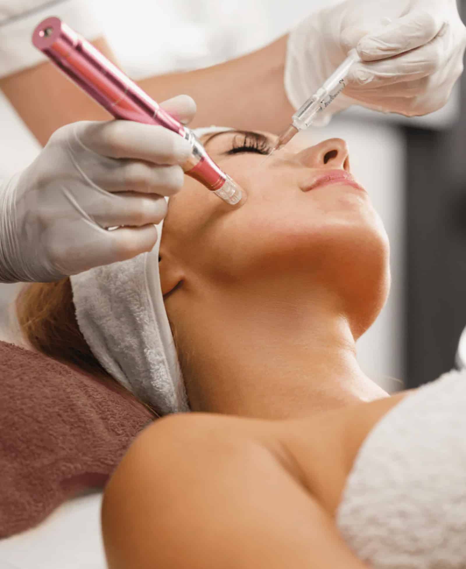 Acne Scar Treatment