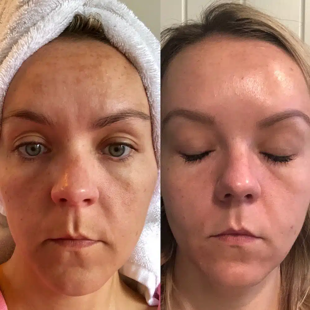 coolmax pro peel treatment