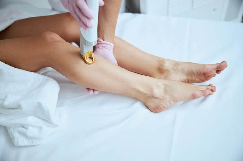 laser hair removal vs waxing