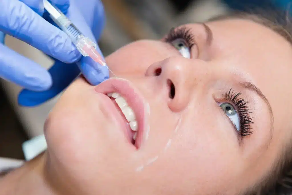 Best Non-Surgical Treatment for Nasolabial Folds