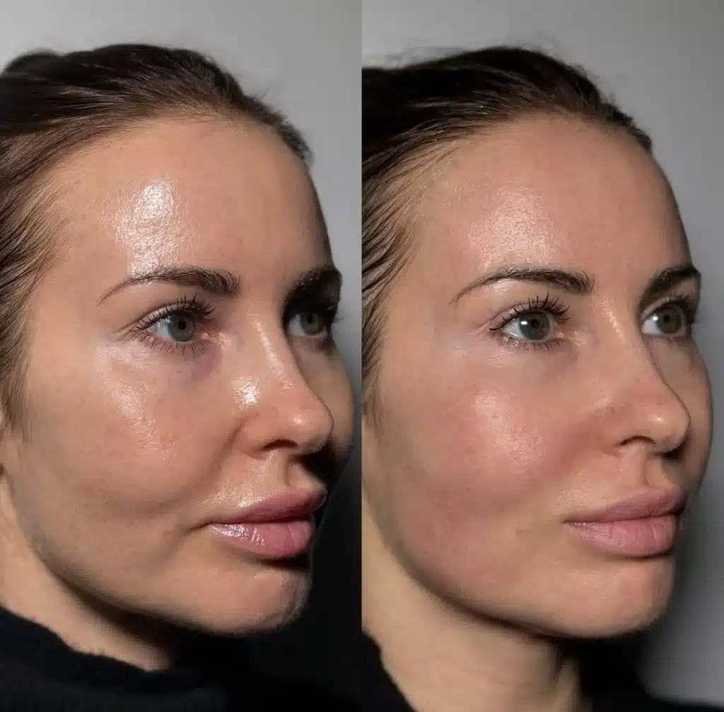 Best Non-Surgical Treatment for Nasolabial Folds