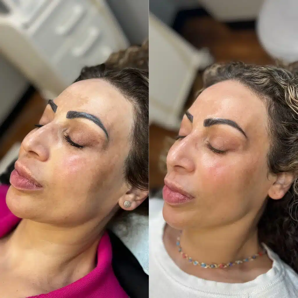 CoolMax Pro Peel recovery time