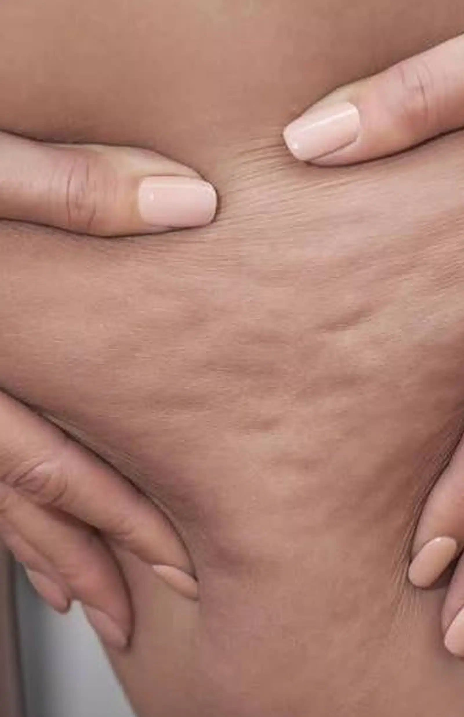 Dermal Matrix to Eliminate Cellulite Hand Rejuvenation