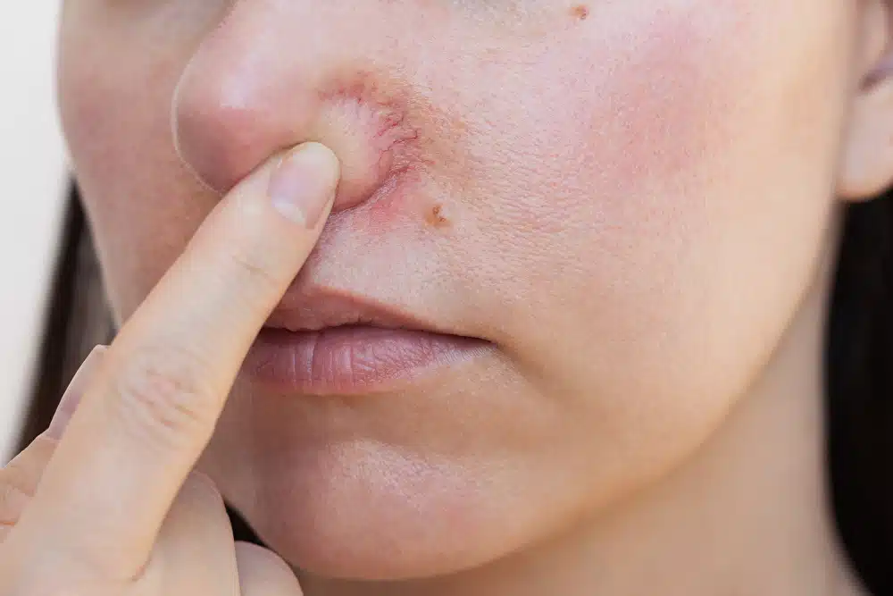 best treatment for broken capillaries
