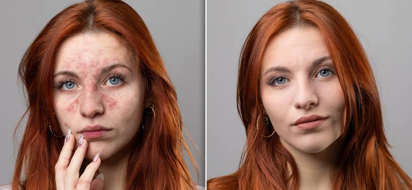 best treatment for broken capillaries