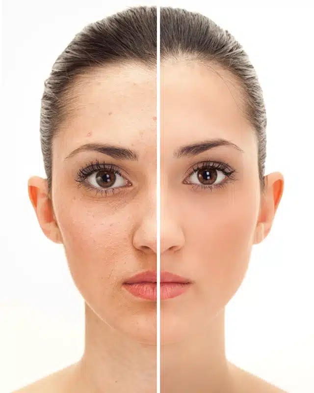 coolmax pro Peel coolmax pro Peel