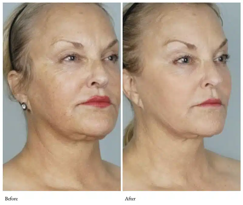 coolmax pro peel vs coolpeel winter park