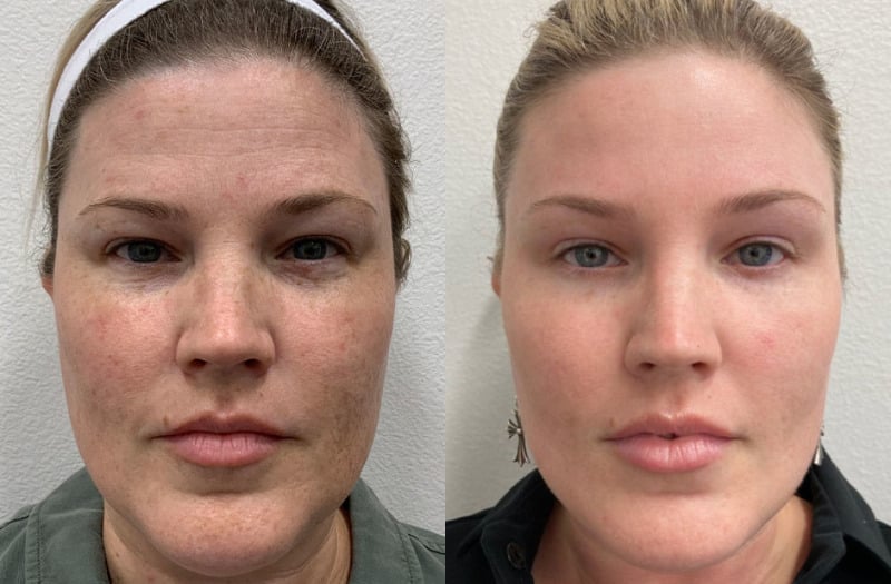 coolmax pro peel vs coolpeel winter park