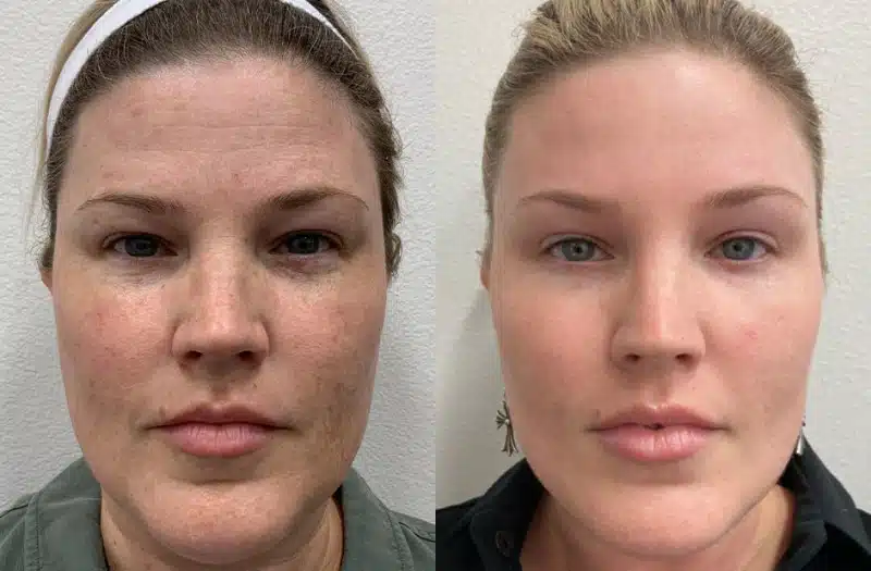 coolmax pro peel vs coolpeel winter park