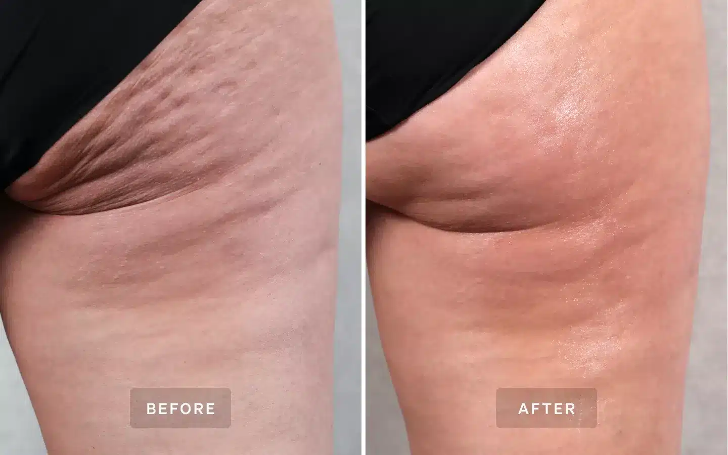 laser cellulite reduction winter park