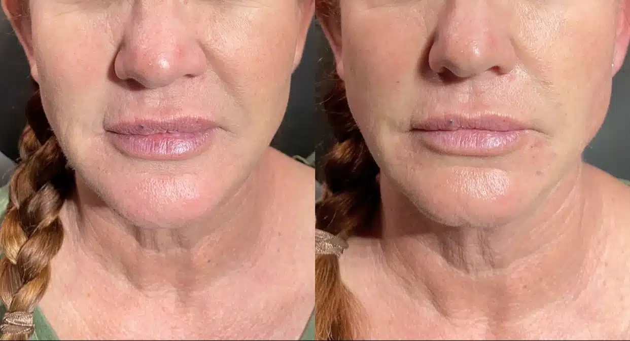 thread lift vs face lift