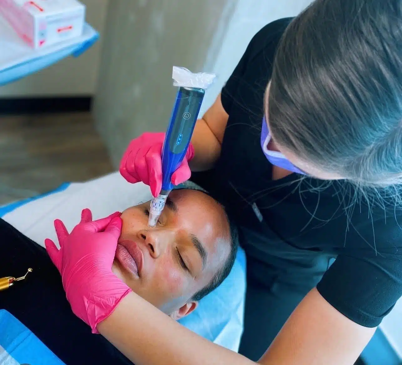 RF Microneedling Improve Acne Scars
