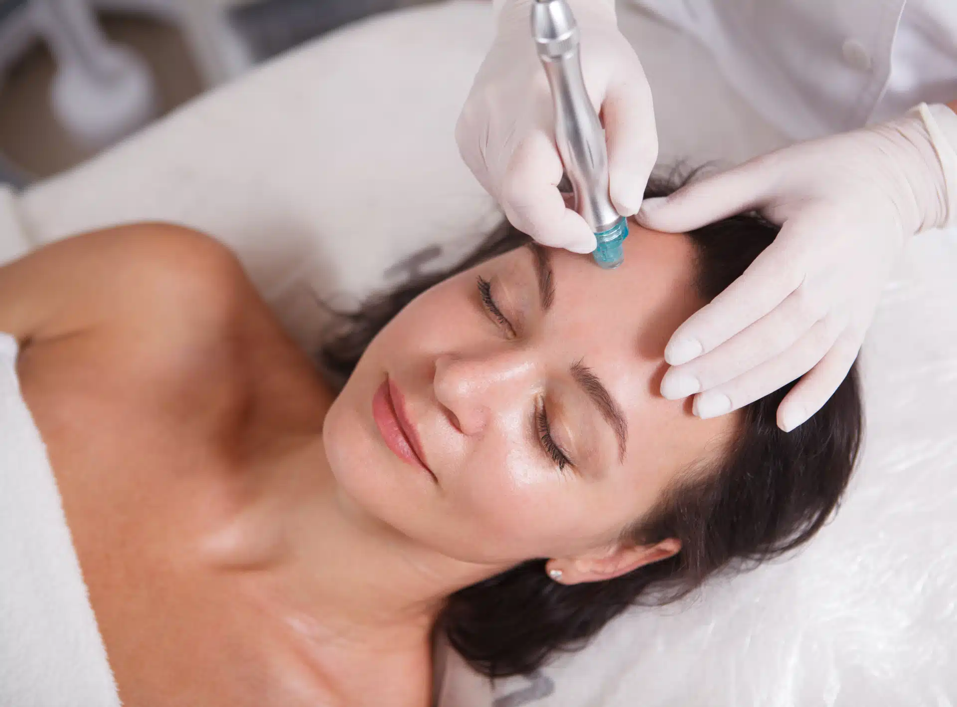 RF Microneedling Improve