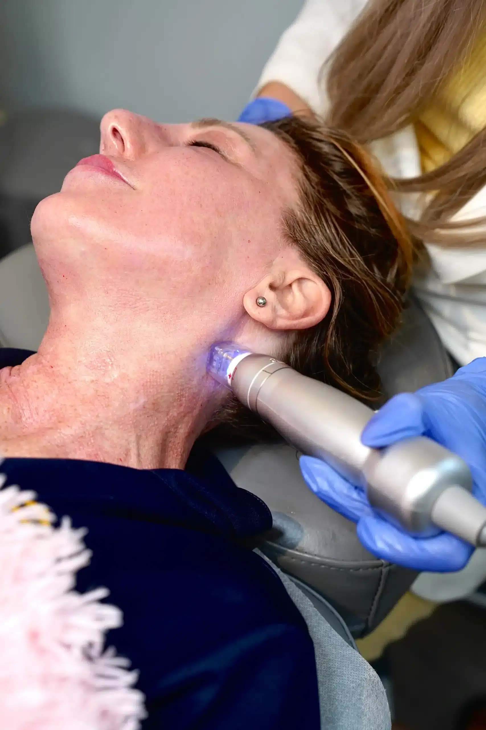 RF Microneedling in Orlando