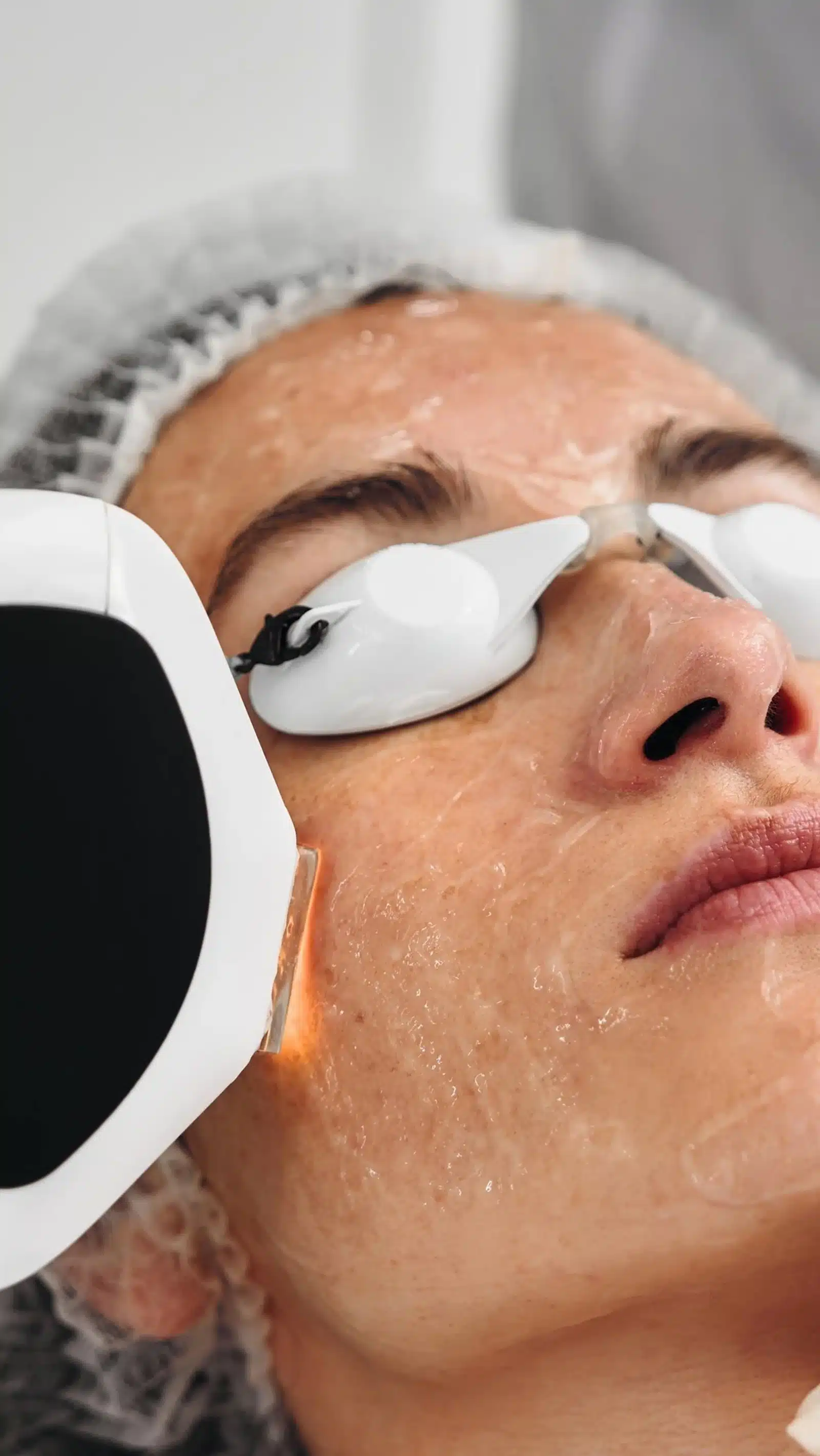 Sun Damage Treatment and blood vessel removal