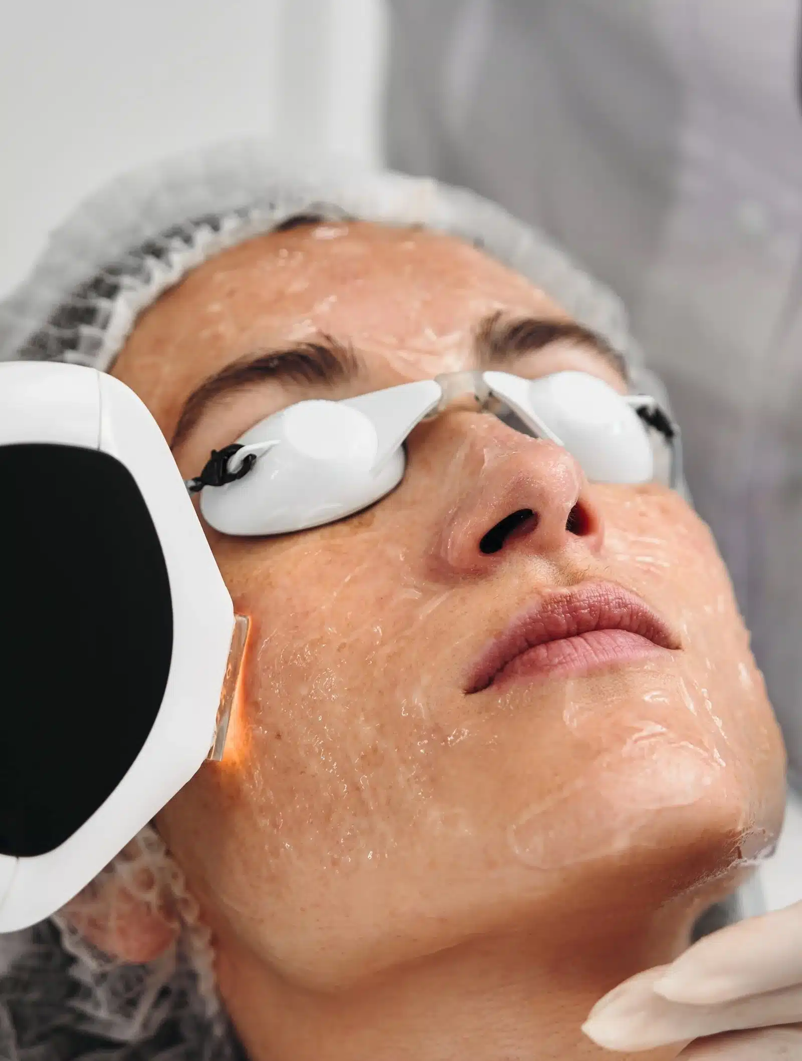 Laser treatment for sun damage and uneven pigmentation Laser treatment for sun damage and uneven pigmentation