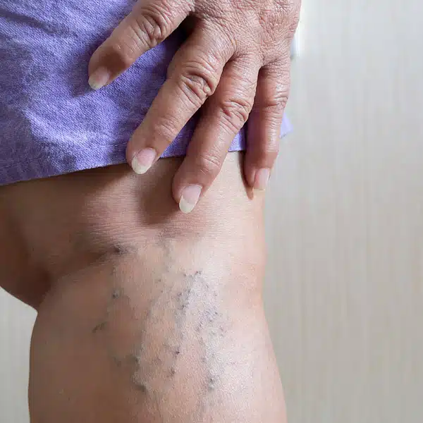 Vein Treatment Sessions