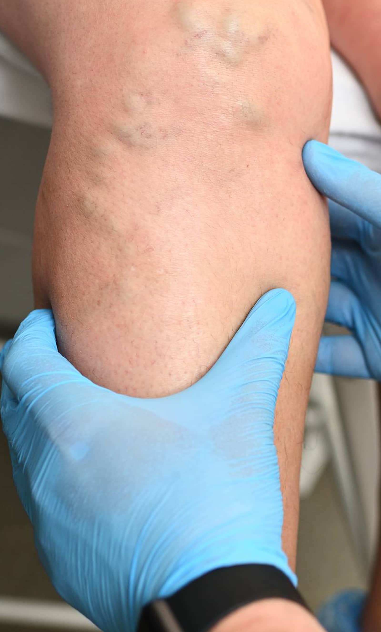 Visible Veins Become a Cosmetic Concern