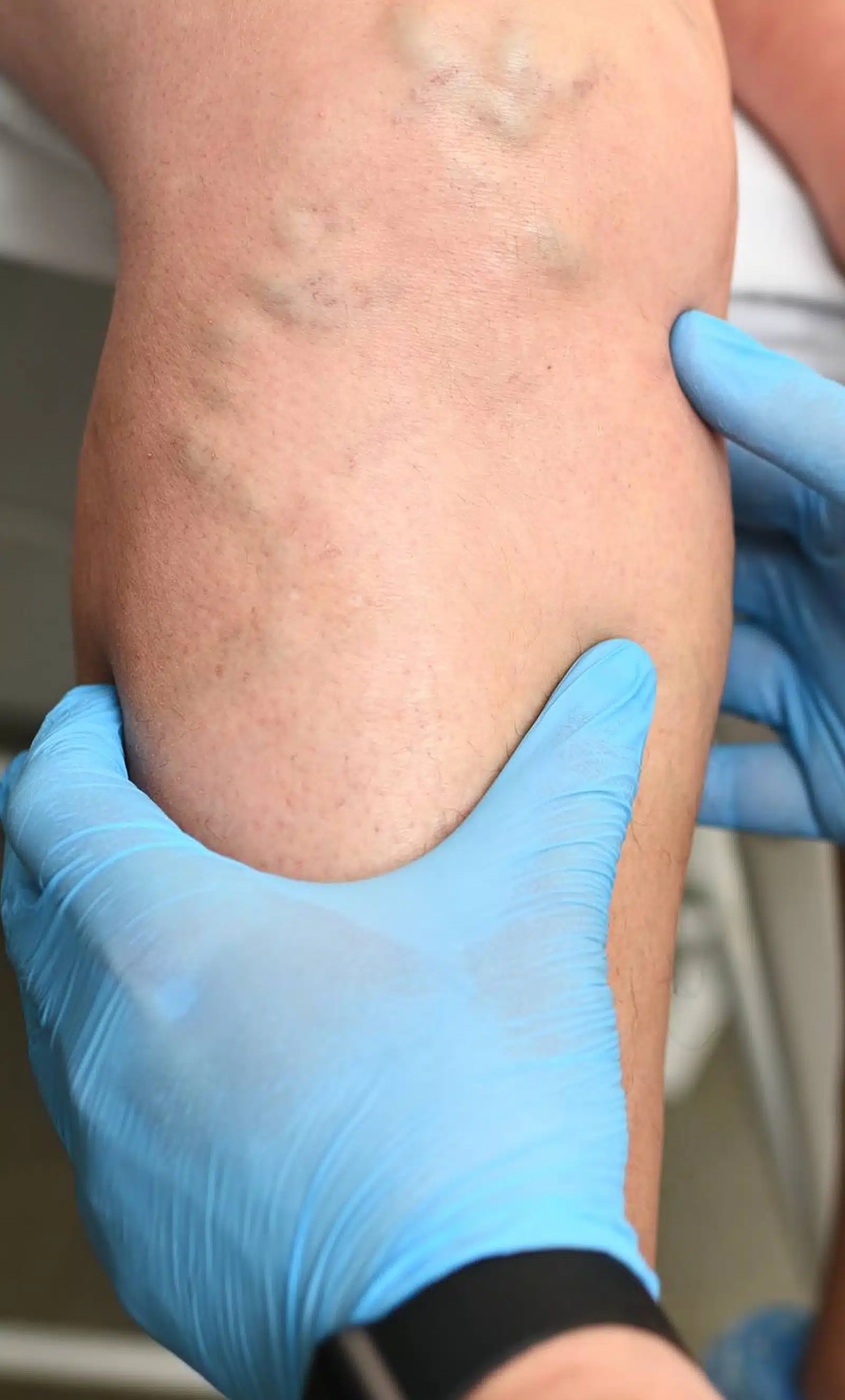 Visible Veins Become a Cosmetic Concern