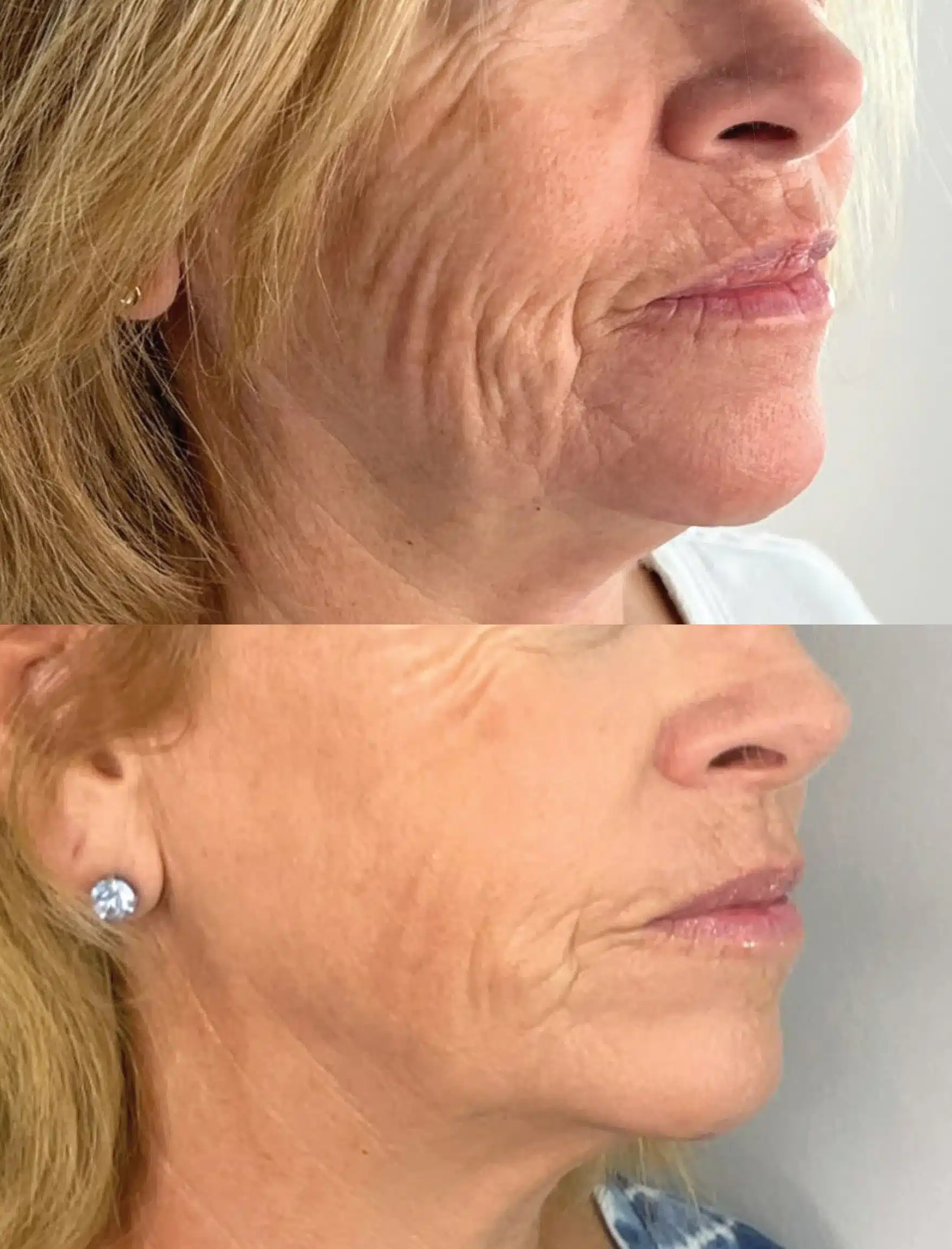 Wymore Laser for RF Microneedling Orlando