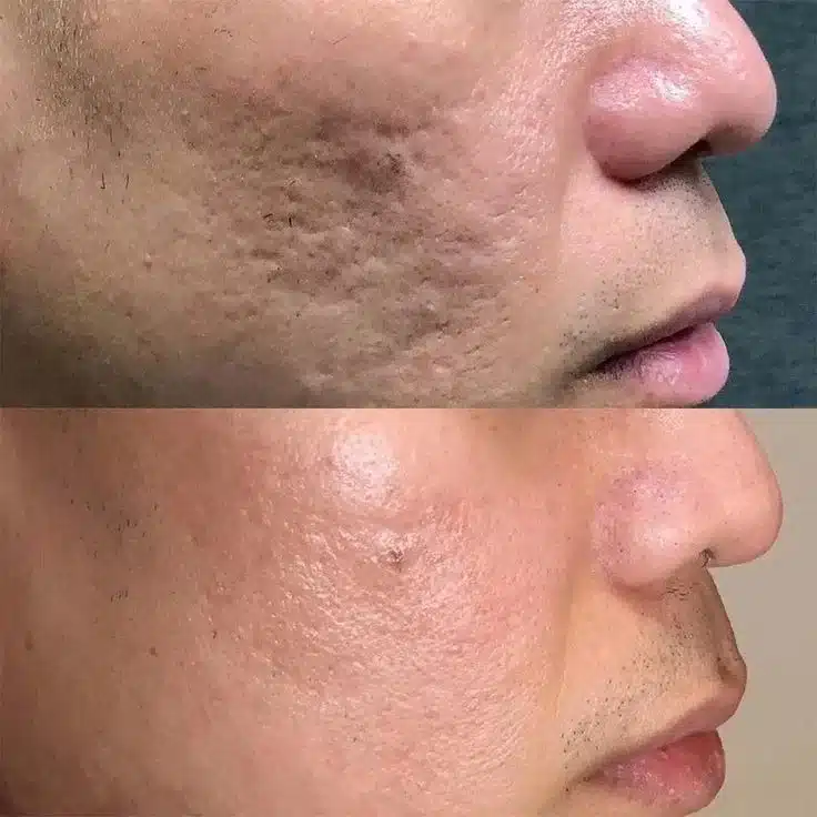 Scar Treatment